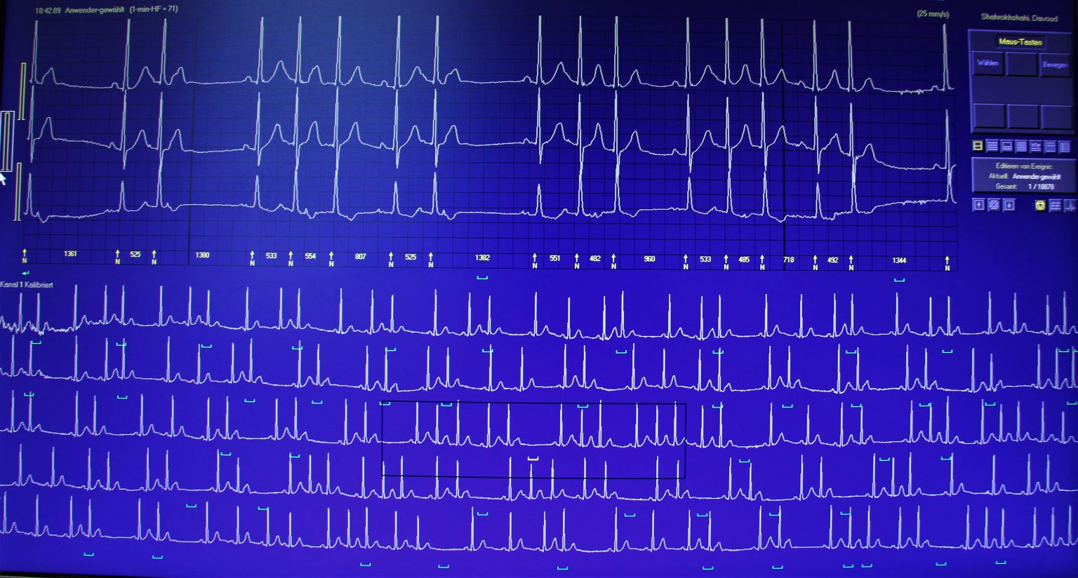 Wie Sieht Ein Langzeit Ekg Aus EKG – Kardiologische Praxis Lippstadt
